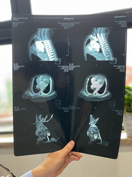 該患兒術(shù)前心臟CT。莢天宇攝
