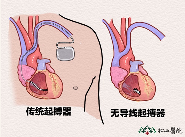 傳統(tǒng)起搏器與無導(dǎo)線起搏器對比。重慶松山醫(yī)院供圖