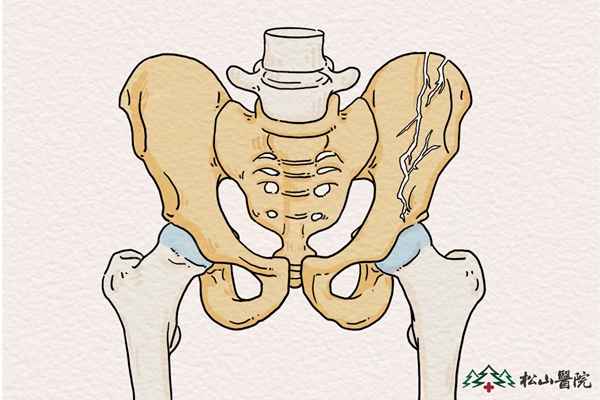 骨盆骨折示意圖。重慶松山醫(yī)院供圖