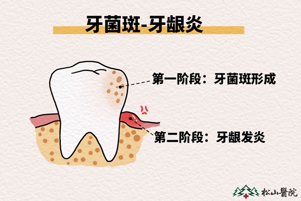 牙齦炎的形成過(guò)程。重慶松山醫(yī)院供圖