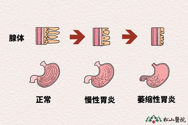 萎縮性胃炎。重慶松山醫(yī)院供圖