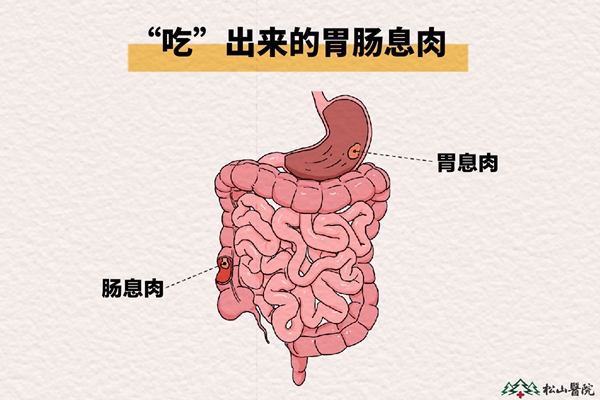 胃腸息肉。重慶松山醫(yī)院供圖