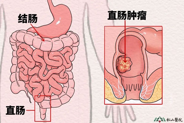 直腸腫瘤示意圖。重慶松山醫(yī)院供圖